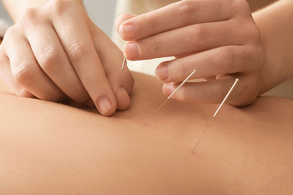 Acupuncture for weight loss 1 - لاغری موضعی با مزوتراپی
