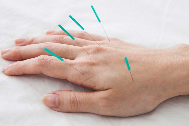 accupuncture - هزینه درمان میگرن با طب سوزنی