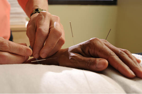 acupunture - بیماری های قابل درمان با طب سوزنی